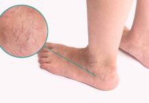 How Long Will You Be Able To Return To Your Daily Tasks After Sclerotherapy? How Long Will You Be Able To Return To Your Daily Tasks After Sclerotherapy